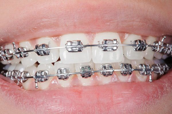 zahnarztinfrankfurt-orthodontics